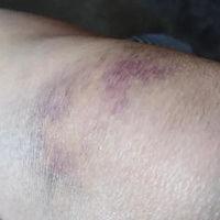 碰伤淤青图片,如何识别和处理碰伤淤青